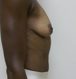 Before Breast Lift