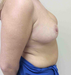 After Breast Lift