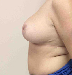 After Breast Lift
