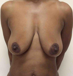 Before Breast Lift