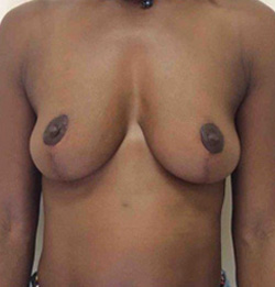 After Breast Lift