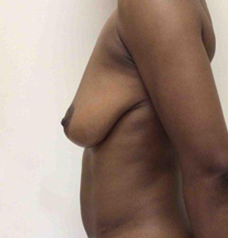 Before Breast Lift