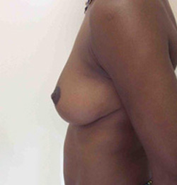 After Breast Lift