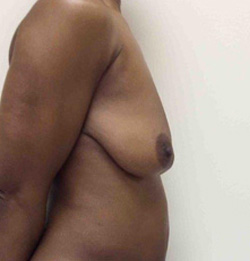 Before Breast Lift