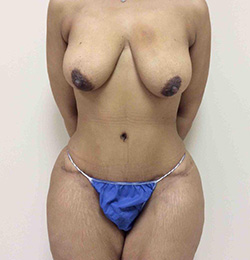 Before Breast Lift
