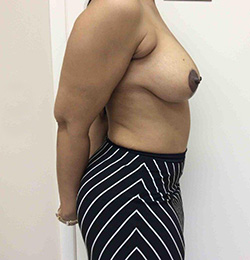 After Breast Lift