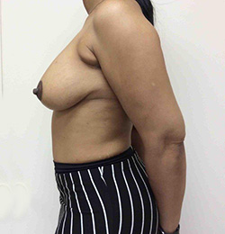 After Breast Lift