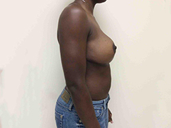 After Breast Lift