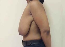 Before Breast Lift