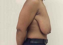 Before Breast Lift