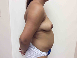 Before Breast Lift