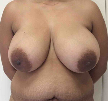 Before Breast Lift