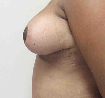 After Breast Lift