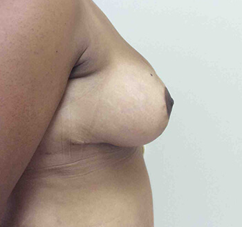 After Breast Lift