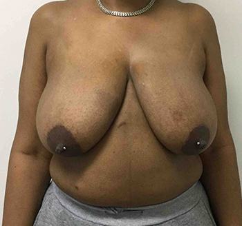 Before Breast Lift
