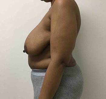 Before Breast Lift