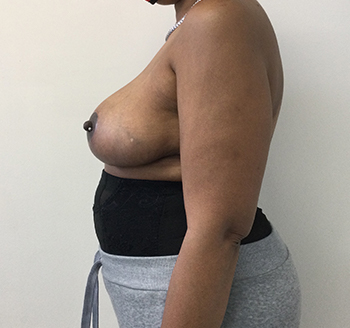 After Breast Lift