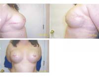 After Breast Reconstruction