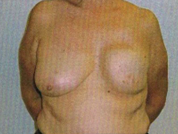 After Breast Reconstruction