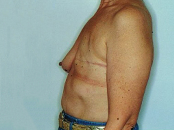 Before Breast Reconstruction