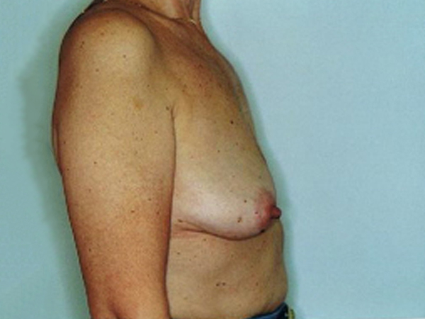 Before Breast Reconstruction