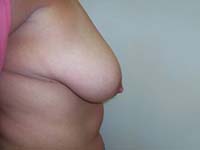 Before Breast Reduction