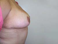 After Breast Reduction