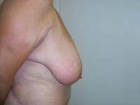 Before Breast Reduction