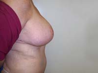 After Breast Reduction