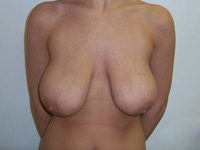 Before Breast Reduction
