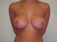 After Breast Reduction