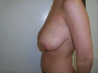Before Breast Reduction