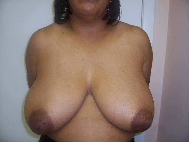 Before Breast Reduction