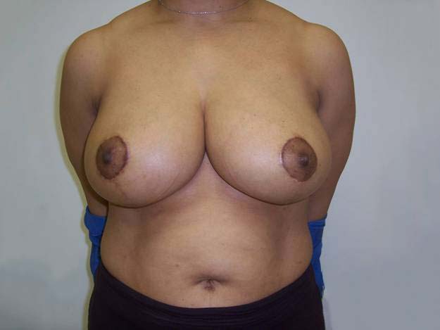 After Breast Reduction