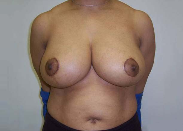 Before Breast Reduction