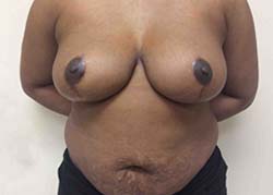 After Breast Reduction