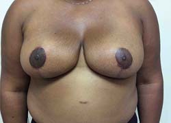 After Breast Reduction