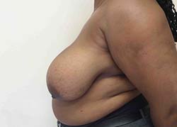 Before Breast Reduction