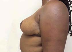 After Breast Reduction