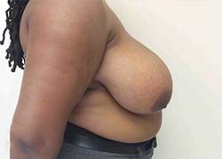 Before Breast Reduction