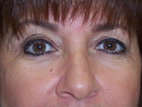 Before Eyelid Lift