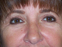 After Eyelid Lift