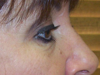 Before Eyelid Lift