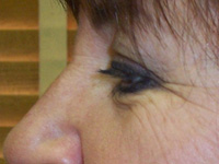Before Eyelid Lift