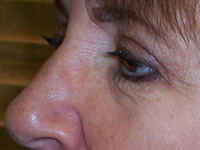After Eyelid Lift