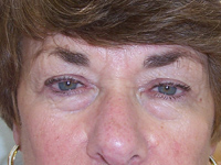 Before Eyelid Lift