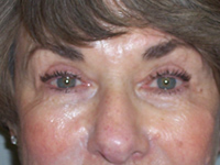 After Eyelid Lift