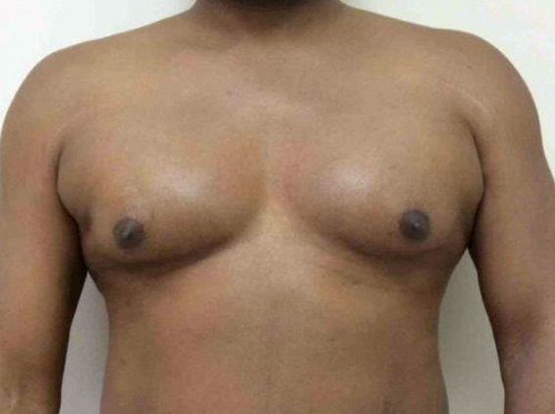 Before Gynecomastia (Male Breast Reduction) in NY and NJ