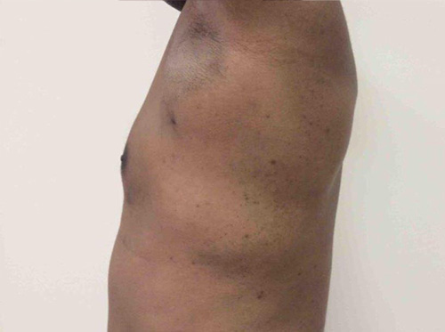 After Gynecomastia (Male Breast Reduction) in NY and NJ
