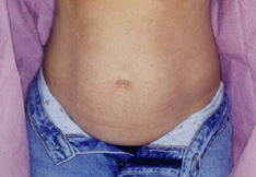 Before Liposuction